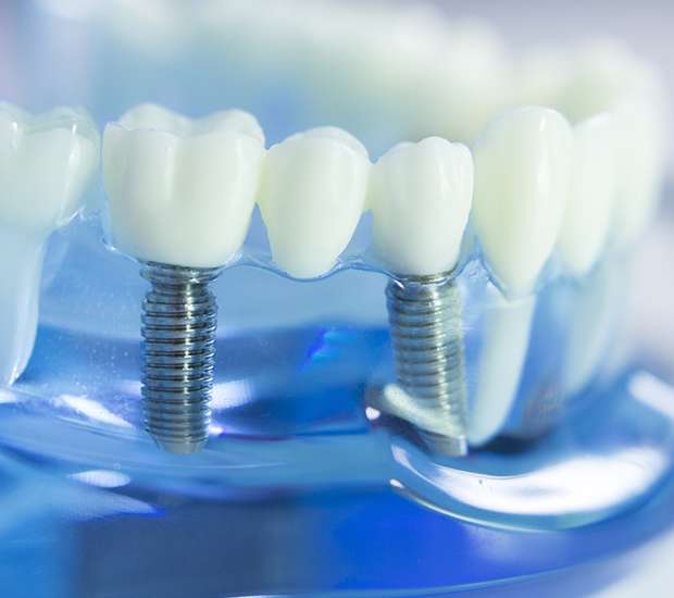 Philadelphia Dental Implants