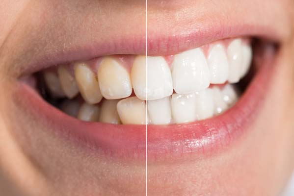 Adjusting The Smile Line In Your Smile Makeover